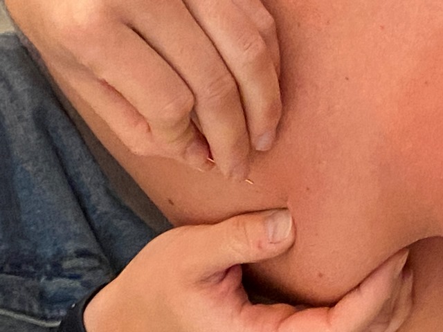 Dry Needling Detail, Kine Mobilis Sint-Michiels Brugge